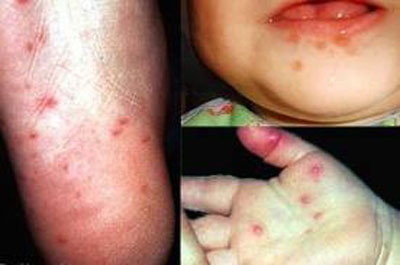 Tổn thương da và niêm mạc ở trẻ nhiễm HIV 1 Tổn thương da và niêm mạc ở trẻ nhiễm HIV 1